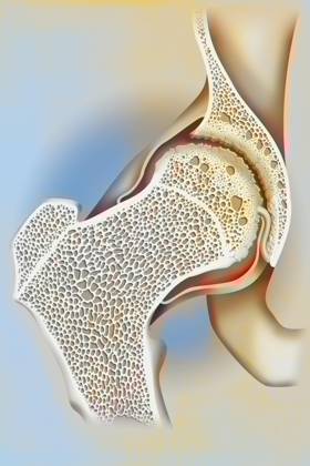 Hip osteoarthritis (femoral head and acetabulum). The cartilage at the femoral head and acetabulum is worn, osteophytes (bony growths) have formed. Bone tissue remodeling also occurs: at the friction regions, bone condensation occurs (osteocondensation) while geodes (cavities) form in the contiguous areas. See images 1531507 for the coxofemoral joint without pathology, 1531707 for osteoporosis and femoral neck fracture. Hip osteoarthritis drawing 016238_051