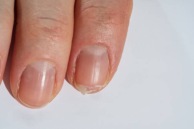 Close-up of brittle nails on woman s hands. Female broken fingernail. weak sore nails. , 51686522.jpg, nail, broken, closeup, finger, female, hand, woman, weak, sore, nails, health, care, skin, manicure, treatment, fingernail, pain, medical, healthy, hygiene, medicine, dry, clean, people, person, ridges, body, background, peeling, brittle, white, gel-lacquer, damaged, unhealthy, gesturing, pitted, fracture, makeup, shellac, break, accident, destroy, fresh, beauty RECORD DATE NOT STATED