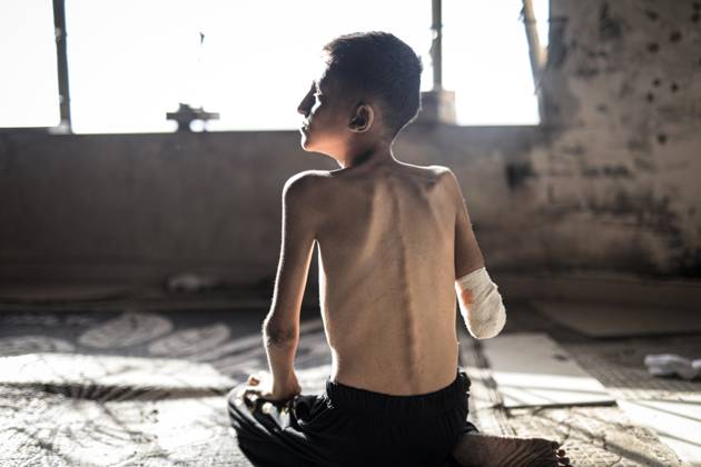 Bilder des Jahres 2025, News 06 Juni News Themen der Woche KW23 News Bilder des Tages Palestinian Ahmad, 14, injured in Gaza, awaits treatment GAZA CITY, GAZA - MAY 31: Ahmad Falih Versh Agha, a 14-year-old boy living in a shelter on Rashid Street, west of Gaza City, who was seriously wounded in the attack on his school, is viewed on May 31, 2025 in Gaza City, Gaza. Ahmad, who lost his right arm in the attack, suffered shrapnel damage to his intestines and a broken pelvis. Ahmad, who lost his father in a previous attack, struggles with health problems due to malnutrition. Ahmad, who needs a prosthetic arm, hopes to be treated abroad. Ahmed Jihad Ibrahim Al-arini Anadolu Gaza City Gaza. Editorial use only. Please get in touch for any other usage.  Copyright: x2025xAnadoluxAhmedxJihadxIbrahimxAl-arinix