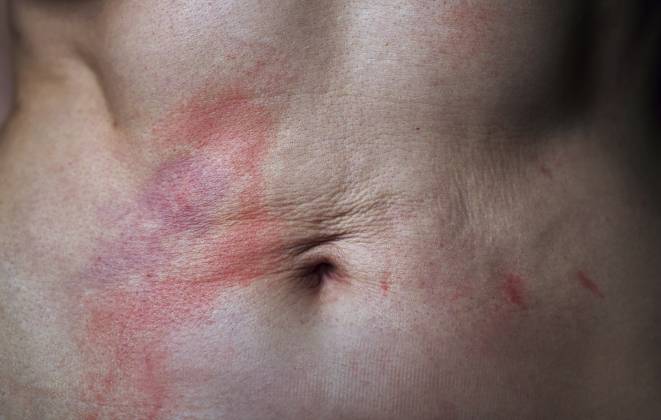 Close up of abdomen with psoriasis redness irritation and scar tissue model released, Symbolfoto, AZF00697
