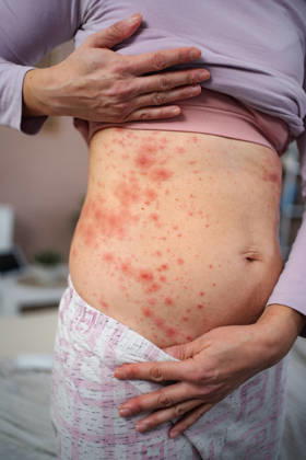 Frau mit rotem Hautausschlag am Bauch Woman feeling uncomfortable with allergic skin rash and irritation on her belly (License=RF) ,model released, Symbolfoto Copyright: xZoonar.com JelenaxCvetkovicx 24970743 ,model released, Symbolfoto ,property released