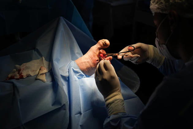 August 25, 2026, Chernihiv, Chernihiv Oblast, Ukraine: WARNING: Graphic content. A surgeon performs a surgery on the foot of a military man at a military hospital in Chernihiv, north of Kyiv, Ukraine, on August 25, 2026. Chernihiv Ukraine  - ZUMAa252 20260825_zip_a252_006 Copyright: xDavidxAllignonx