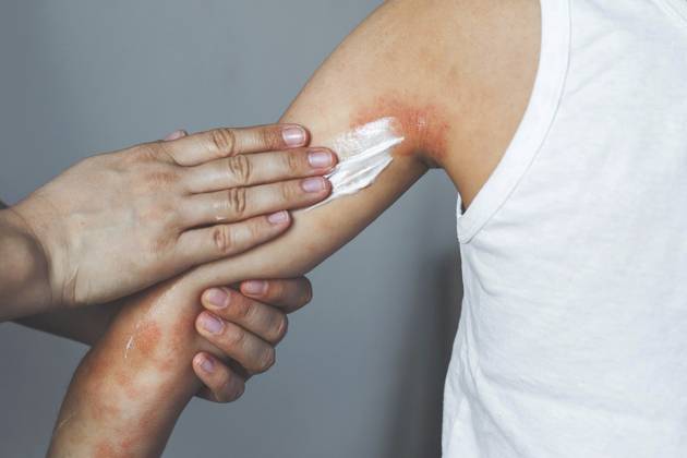 Parts of parents, the beruhigend cream on the inded skin at arm a kind, the under a strong schub of atopical dermatitis eczem, medical skin care, pädiatrische Dermatology, linderung von Allergiesymptomen and heilungs Elternteil, das beruhigende Creme auf die entzündete Haut am Arm eines Kindes aufträgt, das unter einem schweren Schub von atopischem Dermatitis-Ekzem leidet, medizinische Hautpflege, pädiatrische Dermatologie, Linderung von Allergiesymptomen und Heilungs Copyright: imageBROKER EvgeniiaxGordeeva ibxiqx18667565.jpg ,model released, Symbolfoto ,property released